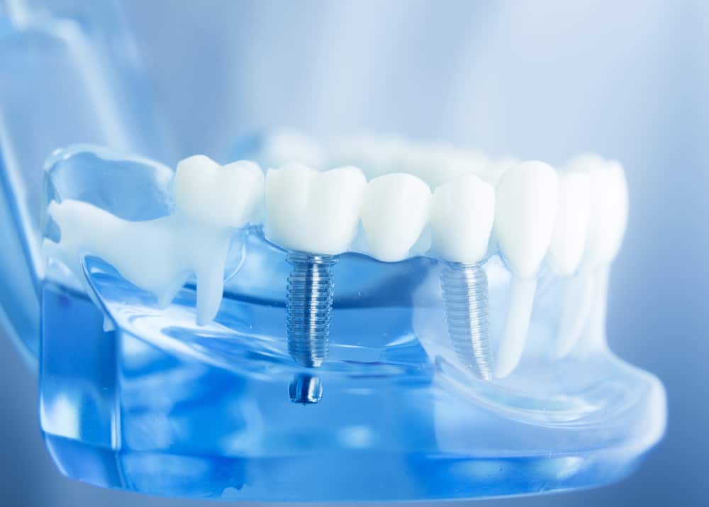 Dental Implants in Dublin