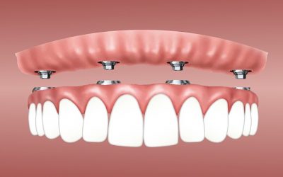 How Does a Dental Implant Retained Dentures Work?
