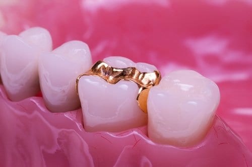 dental inlays and onlays dublin