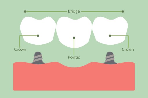 Dental Bridges - Cosmetic Dentist in Dublin