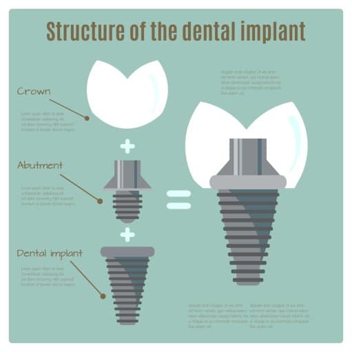 Dental Implants in Dublin